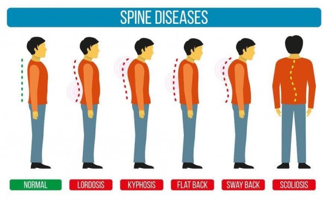 GÙ CỘT SỐNG - BỆNH ĐIỂN HÌNH MÀ AI CŨNG DỄ MẮC